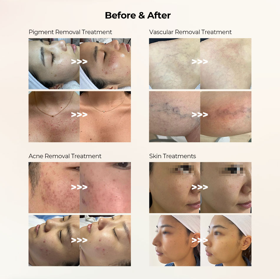 k2 skin treatment before after