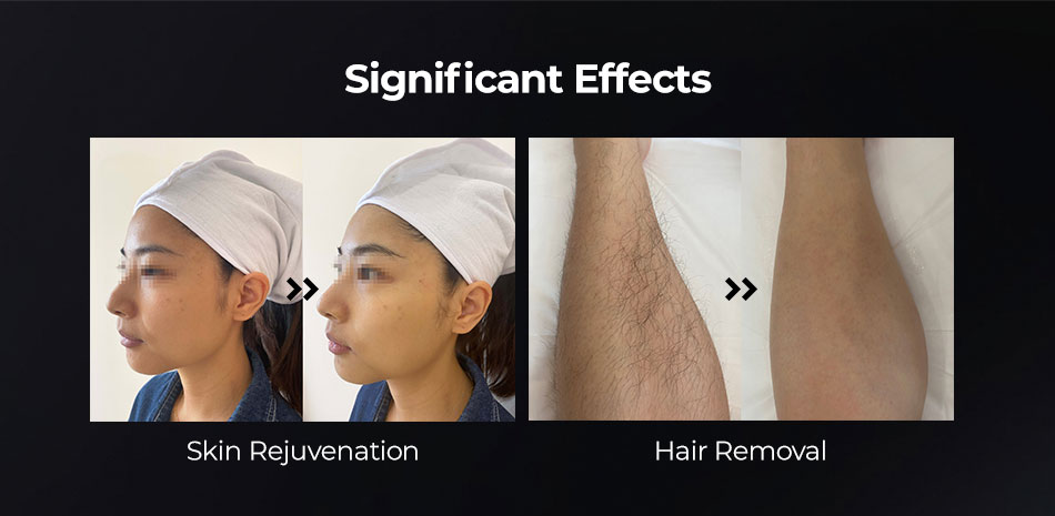 s500 diode laser hair removal skin rejuvenation before after